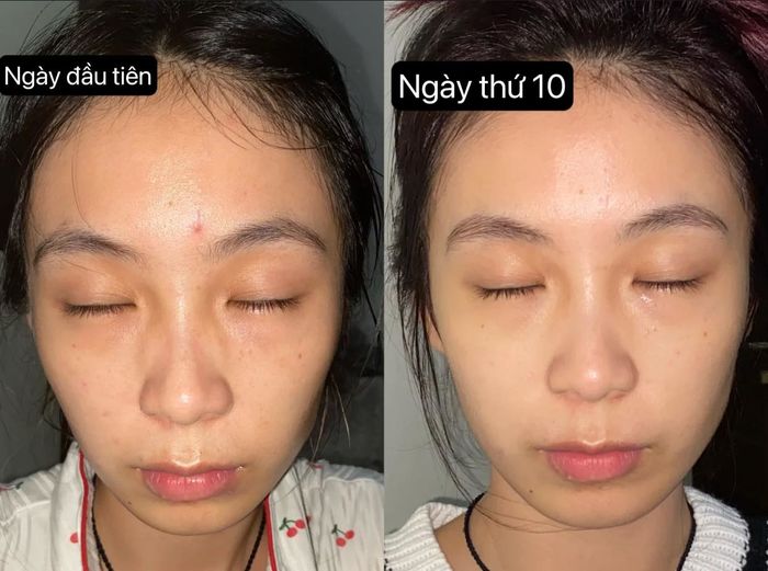 Ngủ trước 23h, làn da thay đổi rõ rệt sau 10 ngày: Giảm thâm mụn