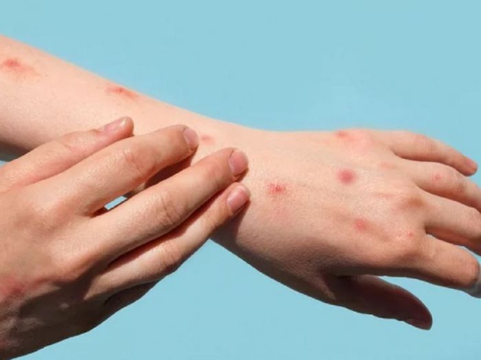 TP.HCM ghi nhận có ca đậu mùa khỉ: Dấu hiệu nhận biết và cách đề phòng