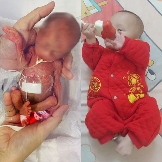 Lần đầu tiên nuôi dưỡng thành công cặp song sinh nặng 500g