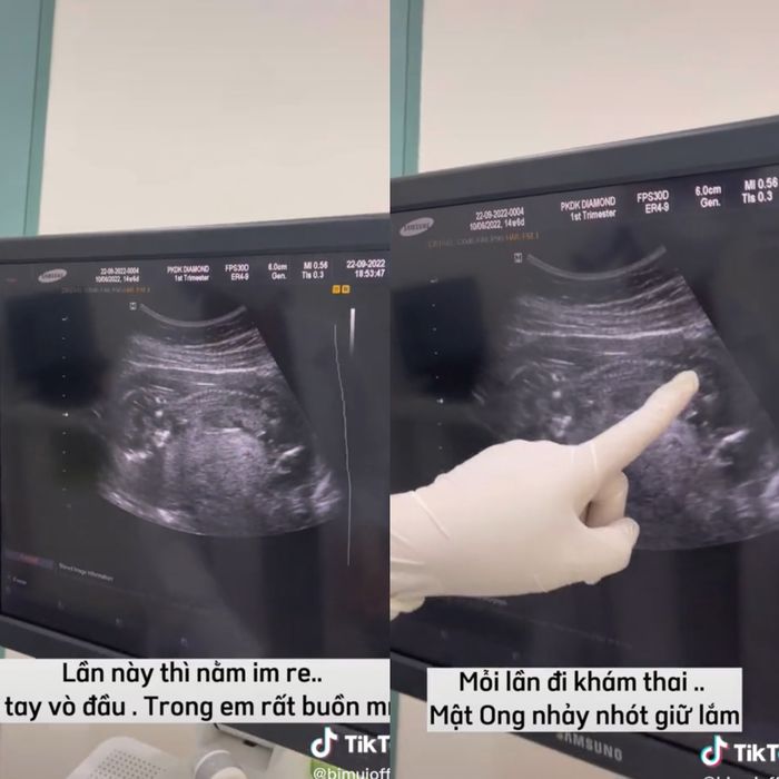 Múi Xù tăng gần 10kg nhưng em bé vẫn thiếu cân, bật khóc vì thương con