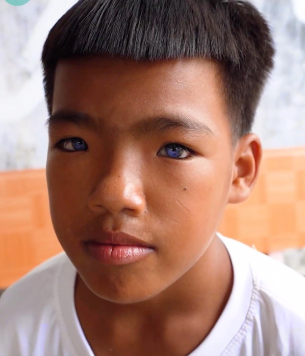 Kỳ lạ những trường hợp mắt 2 màu hiếm có tại Việt Nam 