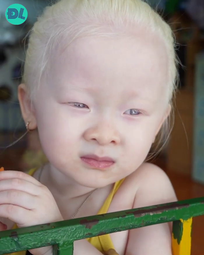 Hy hữu ở Việt Nam: chị em sinh đôi bạch tạng xinh như thiên thần 