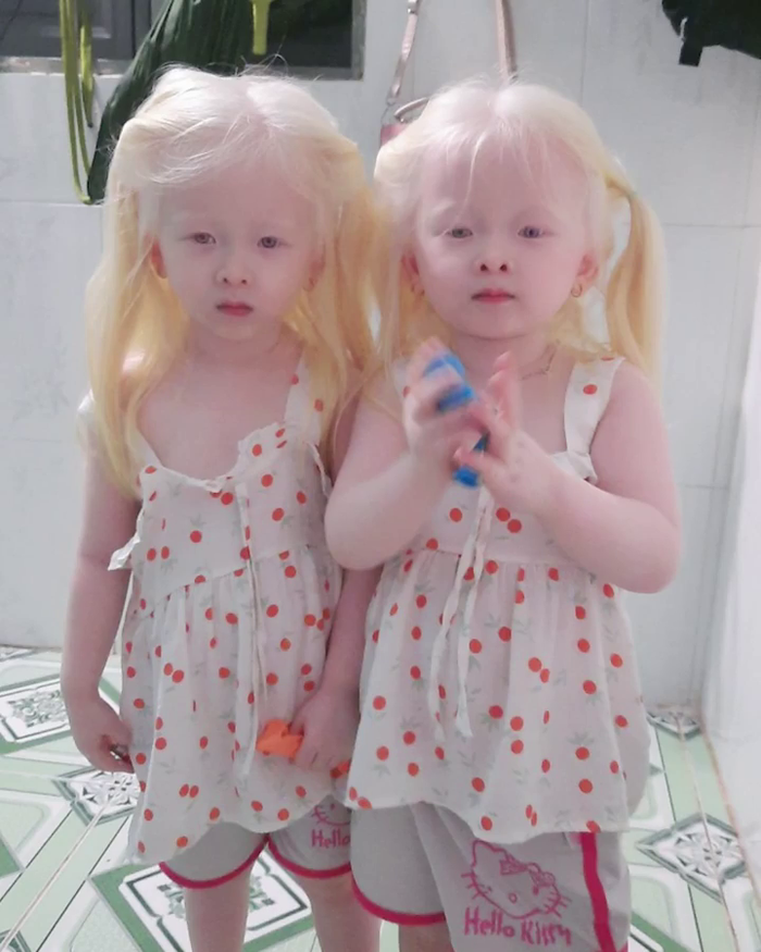 Hy hữu ở Việt Nam: chị em sinh đôi bạch tạng xinh như thiên thần 