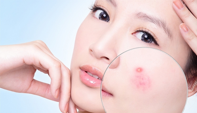 Đắp mặt nạ này, tất cả các loại mụn tự chui ra mà không cần nặn