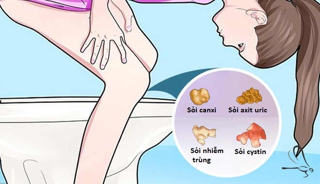 Uống trà đá là 1 trong 11 nguyên nhân phổ biến gây sỏi thận