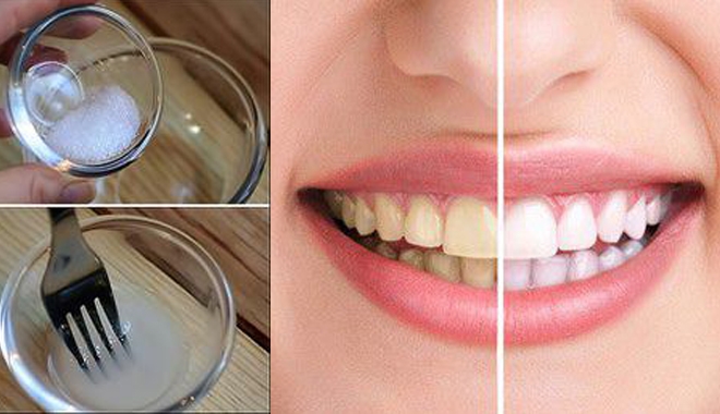 2 cách lấy cao răng tại nhà an toàn bắt buộc phải nhớ