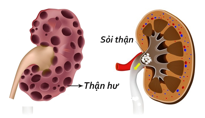 5 cách làm thuốc rượu cực đơn giản giúp tán nhỏ sỏi thận