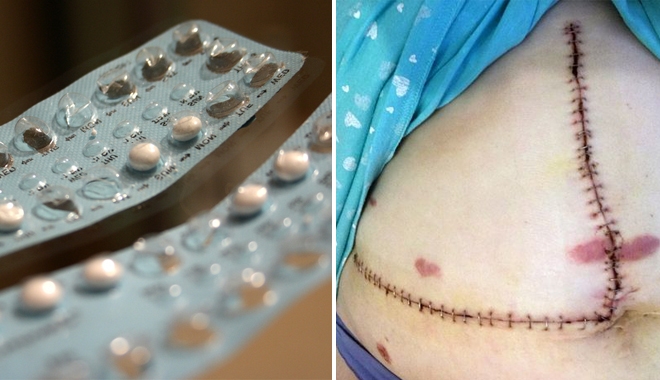 12 năm dùng thuốc tránh thai, cô gái tự chuốc lấy hậu quả thê thảm