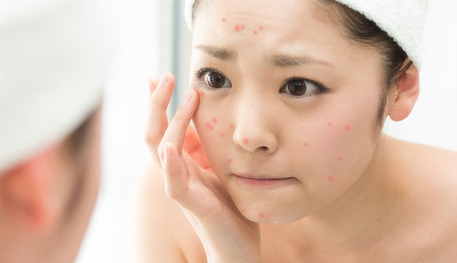 Sai lầm khi điều trị khiến mụn không biến mất mà còn "ê hề" trên da mặt