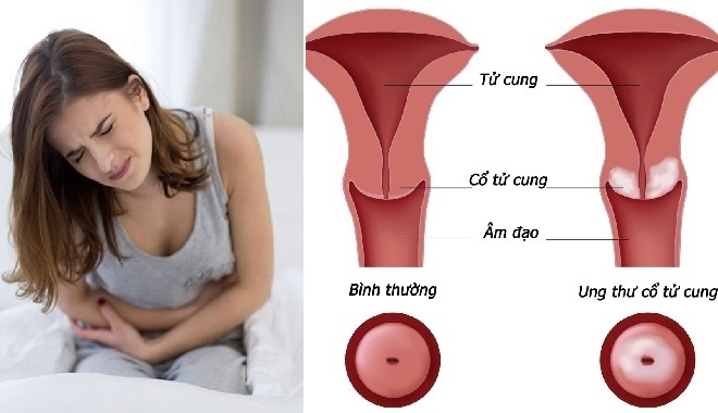 Kết quả hình ảnh cho Äau bụng
