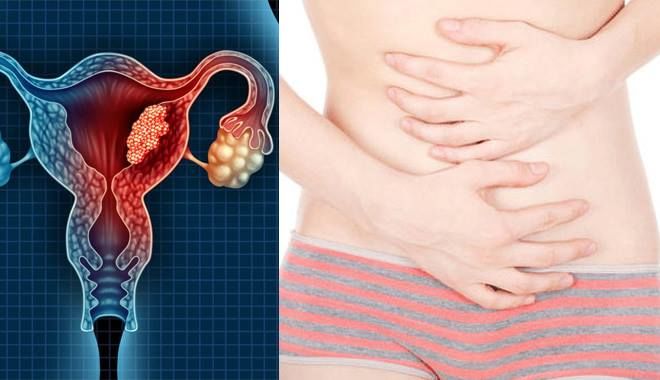 4 dấu hiệu ung thư buồng trứng không quá rõ ràng nên chị em thường chủ quan không để ý