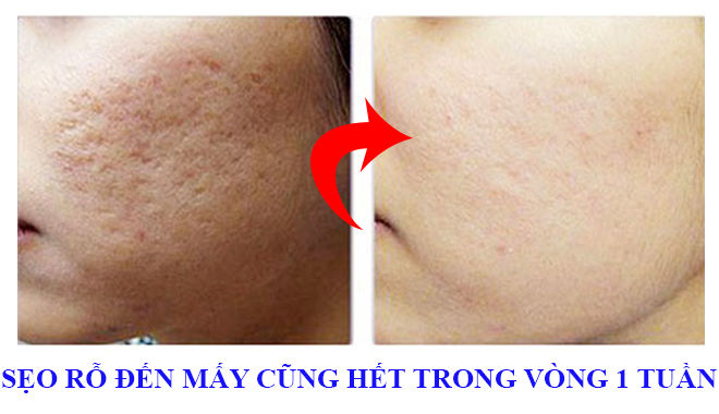 Sẹo rỗ lâu năm đến mấy cũng hết trong vòng 1 tuần với bí quyết ít ai biết đến