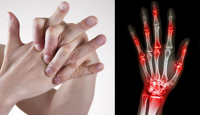 Giật mình với nguồn gốc của tiếng kêu "rắc rắc" khi bạn bẻ khớp ngón tay chân