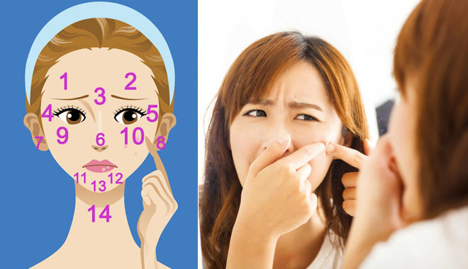 Nhìn 6 vị trí mọc mụn trứng cá trên mặt để biết bộ phận nào trong cơ thể bạn đang gặp rắc rối