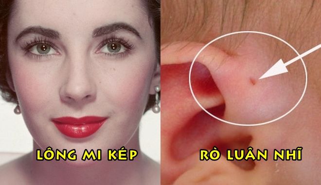 Có những đặc điểm cơ thể này bạn thuộc “hàng hiếm” trên thế giới