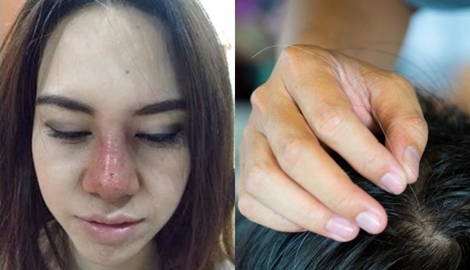 Nặn mụn, nhổ tóc bạc và những việc làm nên bỏ ngay nếu không muốn gặp nguy hiểm