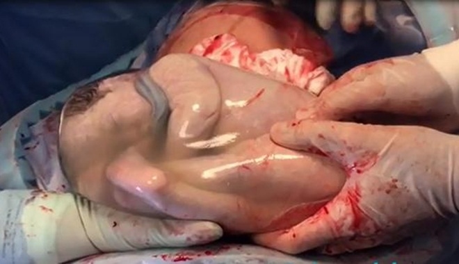Khoảnh khắc sinh ba diệu kì: 2 bé dù đã ra khỏi lòng mẹ vẫn "ngủ ngon lành" trong túi ối
