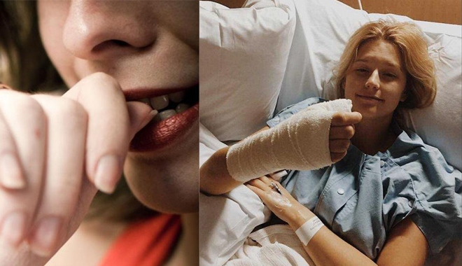 Một nữ sinh đã phải phẫu thuật cắt bỏ ngón cái do thói quen nhiều người mắc phải