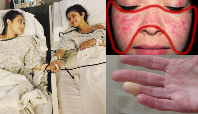 "Lupus ban đỏ" - căn bệnh mà Selena Gomez đang mắc phải là bệnh gì và nguy hiểm ra sao?