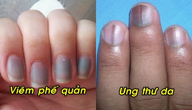 14 dấu hiệu lạ trên móng tay cảnh báo những vấn đề về sức khỏe mà bạn nhất định phải biết