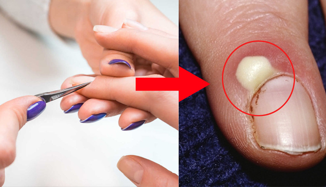Cô gái bị biến chứng nguy hiểm sau khi đi làm móng, bác sĩ cảnh báo 7 điều trước khi vô tiệm nail 