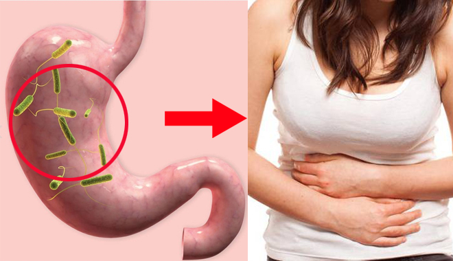 Chuyên gia về tiêu hóa chia sẻ 5 nguyên nhân khá bất ngờ gây viêm loét dạ dày với cả gia đình