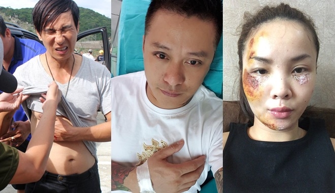 Những lần tai nạn nghiêm trọng của sao Việt: Gãy xương, giảm thị lực, thậm chí biến dạng khuôn mặt