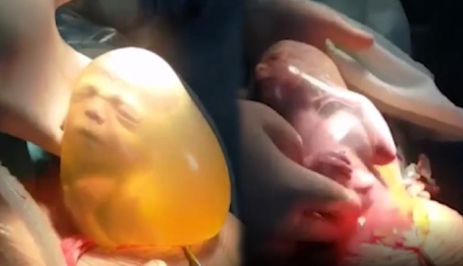 Khoảnh khắc kì diệu: Em bé ngọ nguậy, cố sức chui ra khỏi túi ối để chào đời