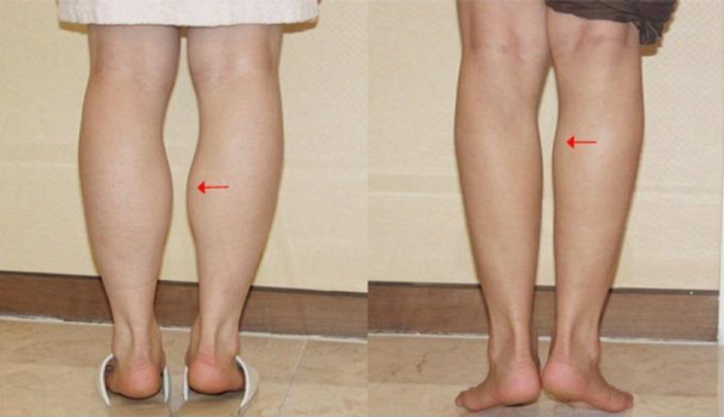 Phương pháp thu nhỏ bắp chân hiệu quả giúp đôi chân thon gọn thẳng tắp 