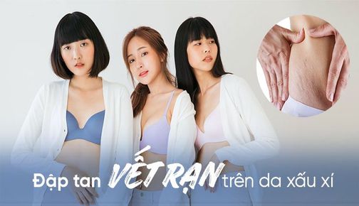 Cải thiện vết rạn xấu xí trên da bằng nước cốt chanh hay dầu dừa