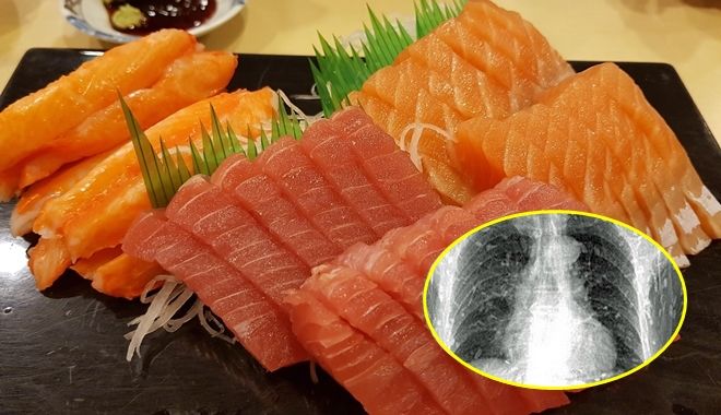 Bức ảnh sán “làm ổ” khắp người gây chú ý cùng lời cảnh báo đừng ăn sushi bẩn