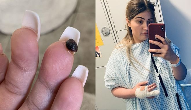 Cô gái bị nhiễm trùng suýt mất ngón tay vì thói quen sơn móng làm đẹp 