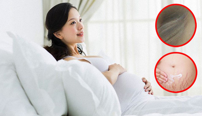 BS bệnh viện Từ Dũ: "Hơn 85% phụ nữ đối diện với thâm nám mang thai"