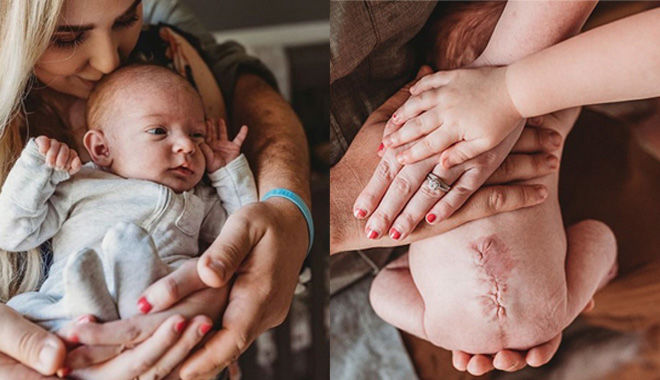 Em bé được sinh ra với vết sẹo trên lưng do chào đời hai lần