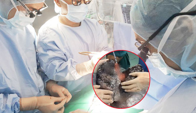 Lá phổi đen của người đàn ông 52 tuổi qua đời sau 30 năm hút thuốc lá