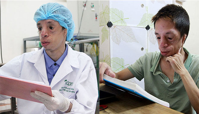 Nỗ lực của chàng trai không tai, biến dạng sọ mặt