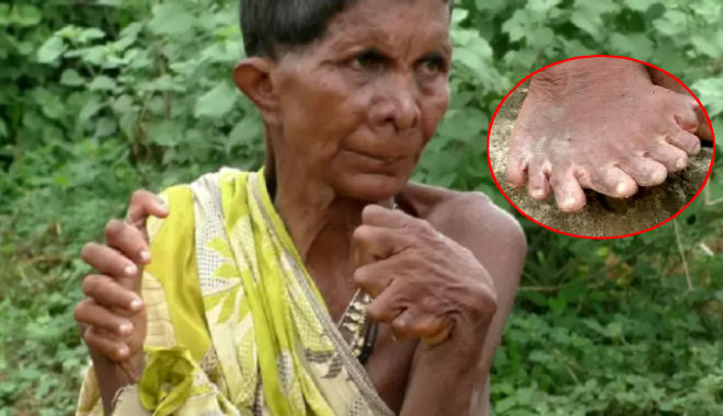 Người phụ nữ có 20 ngón chân, 12 ngón tay khổ sở vì bị coi là phù thủy