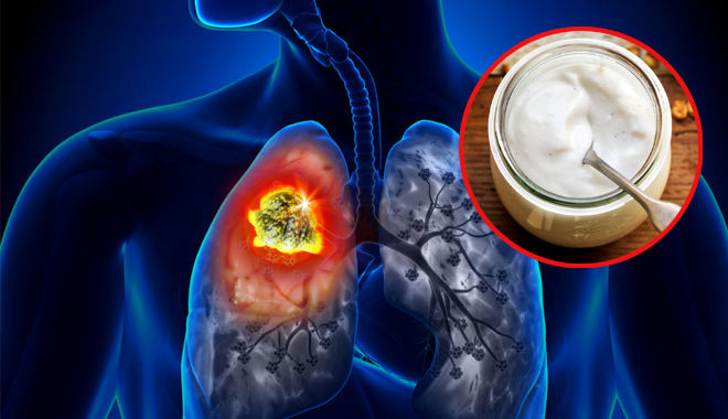 Tạp chí Mỹ: Ăn nhiều chất xơ giúp giảm nguy cơ ung thư phổi 
