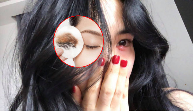 Hòa Minzy bị sưng tấy mắt chỉ vì tẩy trang không đúng cách