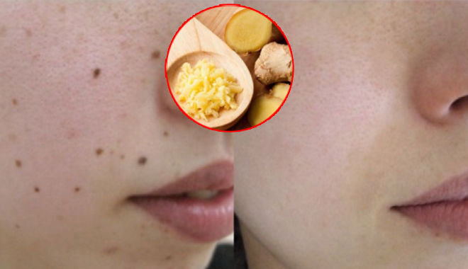 Kinh nghiệm hay: Tẩy nốt ruồi chỉ đơn giản với gừng, tỏi trong nhà bếp