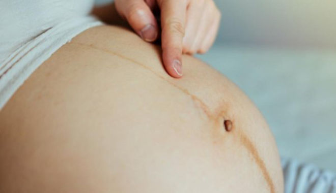 Giải mã nguồn gốc đường sọc nâu thường xuất hiện trên bụng mẹ bầu 