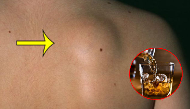 Người đàn ông nổi đầy khối u kỳ dị trên cơ thể vì uống nhiều rượu bia