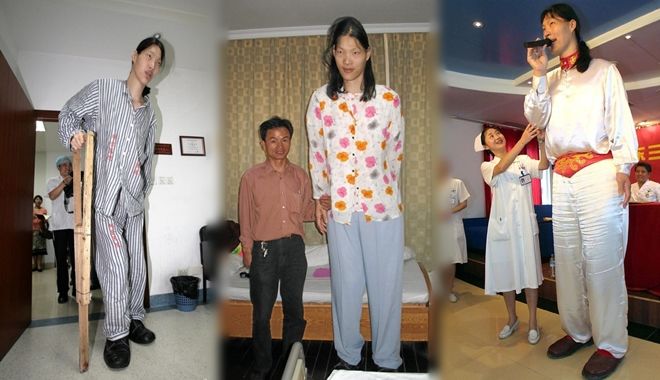 Cô gái 18 tuổi cao 2m48, nặng 60kg hiến xác cho y học khi mất đi