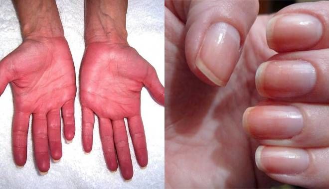 Dấu hiệu tay cho biết nguy cơ mắc bệnh của dạ dày: Lòng tay đỏ rát