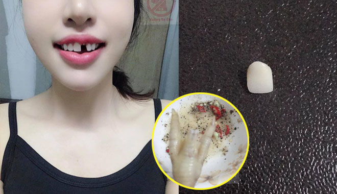 Chỉ vì ăn chân gà luộc, cô gái bị rụng luôn chiếc răng cửa