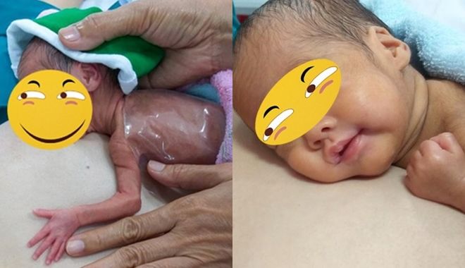 Long An: Bé sinh non 700 gram hồi sinh kì diệu nhờ da kề da sau sinh