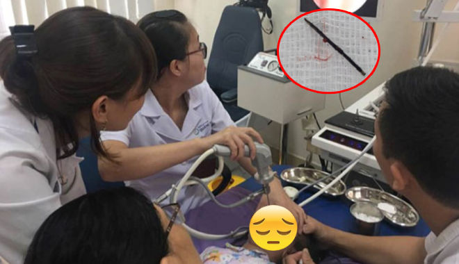 Phú Thọ: Bác sĩ gắp kim khâu gỉ đen 17mm từ trong cơ thể bé gái 3 tuổi