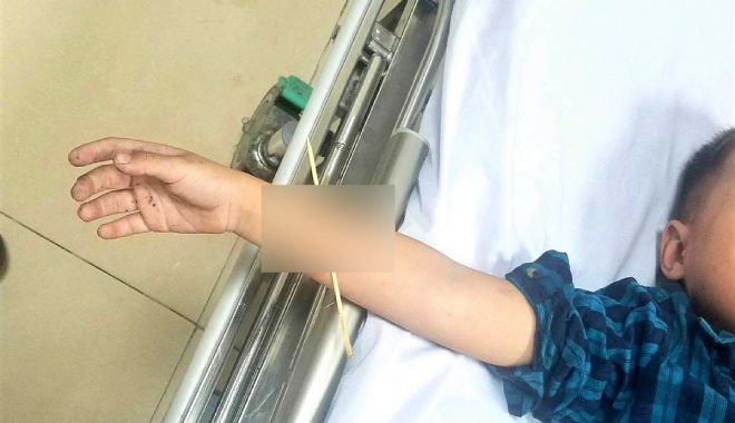 Quảng Ninh: Hy hữu bé trai 6 tuổi bị que xiên thịt xuyên qua cánh tay