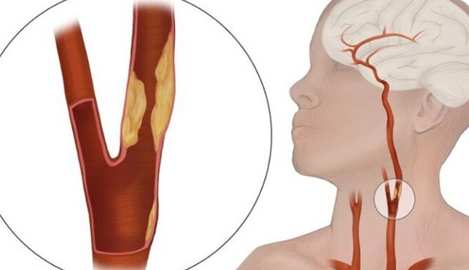 Bác sĩ Bệnh viện 108: Người trẻ nên siêu âm mạch cảnh phòng đột quỵ
