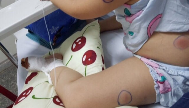 Cháu bé 6 tuổi nhiễm vi khuẩn "ăn thịt người" sau khi bị gà mổ chân
